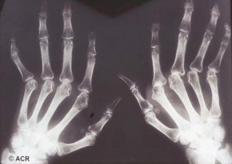 蜂王漿治療風濕，有風濕能吃蜂蜜和蜂王漿嗎?